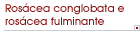 Ros�cea conglobata e ros�cea fulminante
