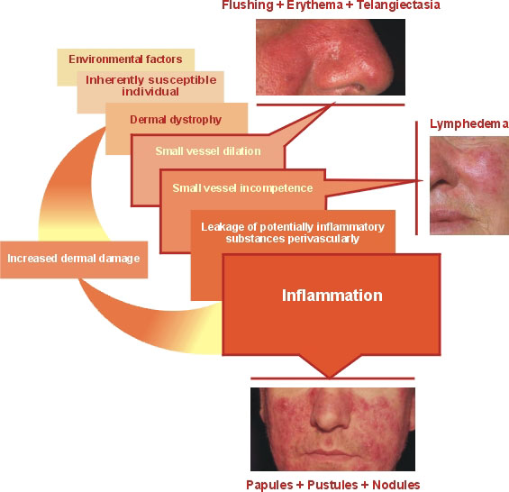 What causes rosacea?